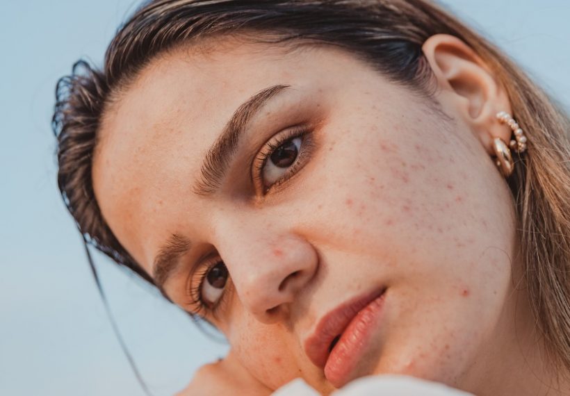 une femme qui a de l'acné à cause d'une exposition solaire non protégée