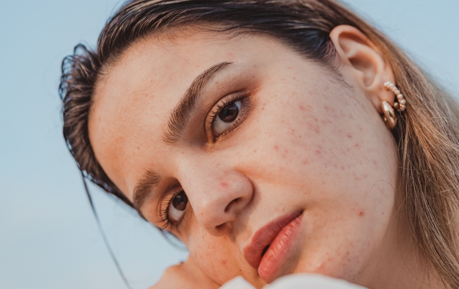 une femme qui a de l'acné à cause d'une exposition solaire non protégée