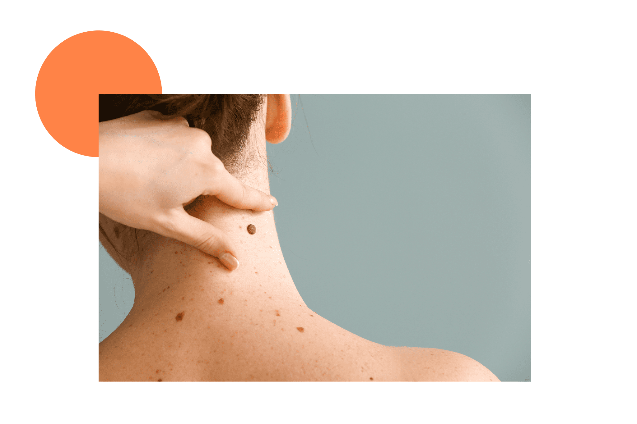 grains de beauté sur la nuque et le dos d'une femme
