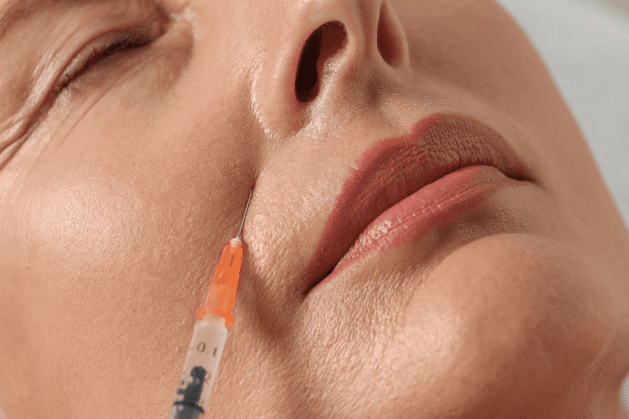 Zoom sur le visage d'une femme qui fait une injection de radiesse pour combler ses rides