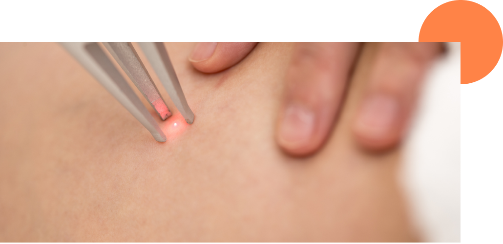 zoom sur une séance de laser vasculaire sur les bras