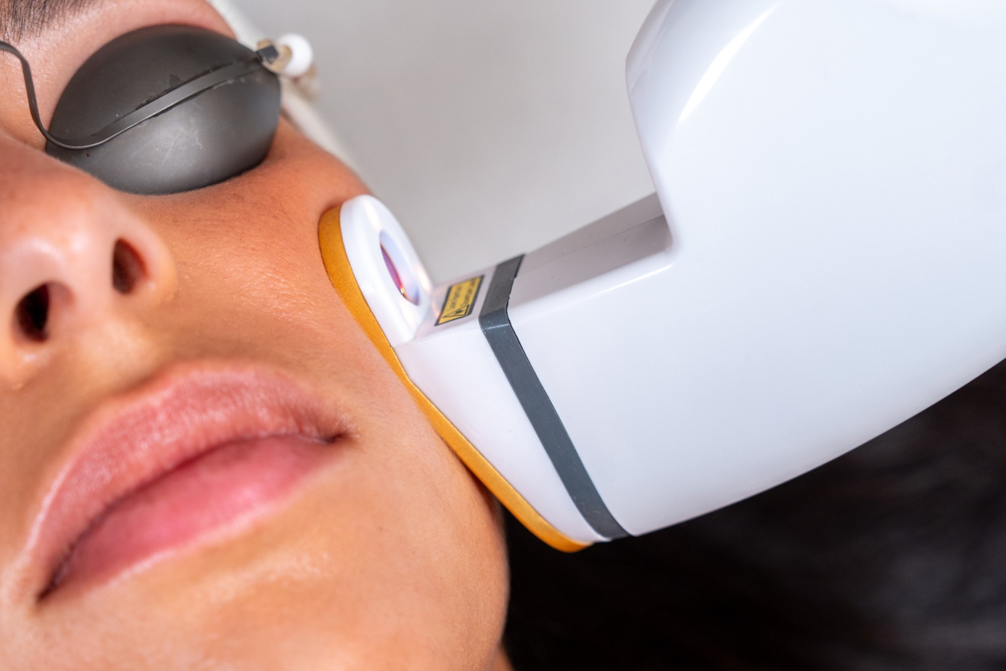 Séance de laser visage à Lille