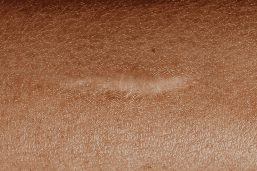 une personne qui fait un massage sur son bras pour enlever sa cicatrice