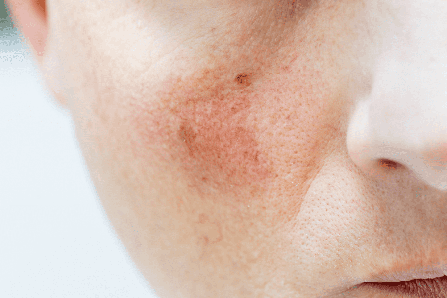 zoom sur des joues d'une femme avec de la couperose