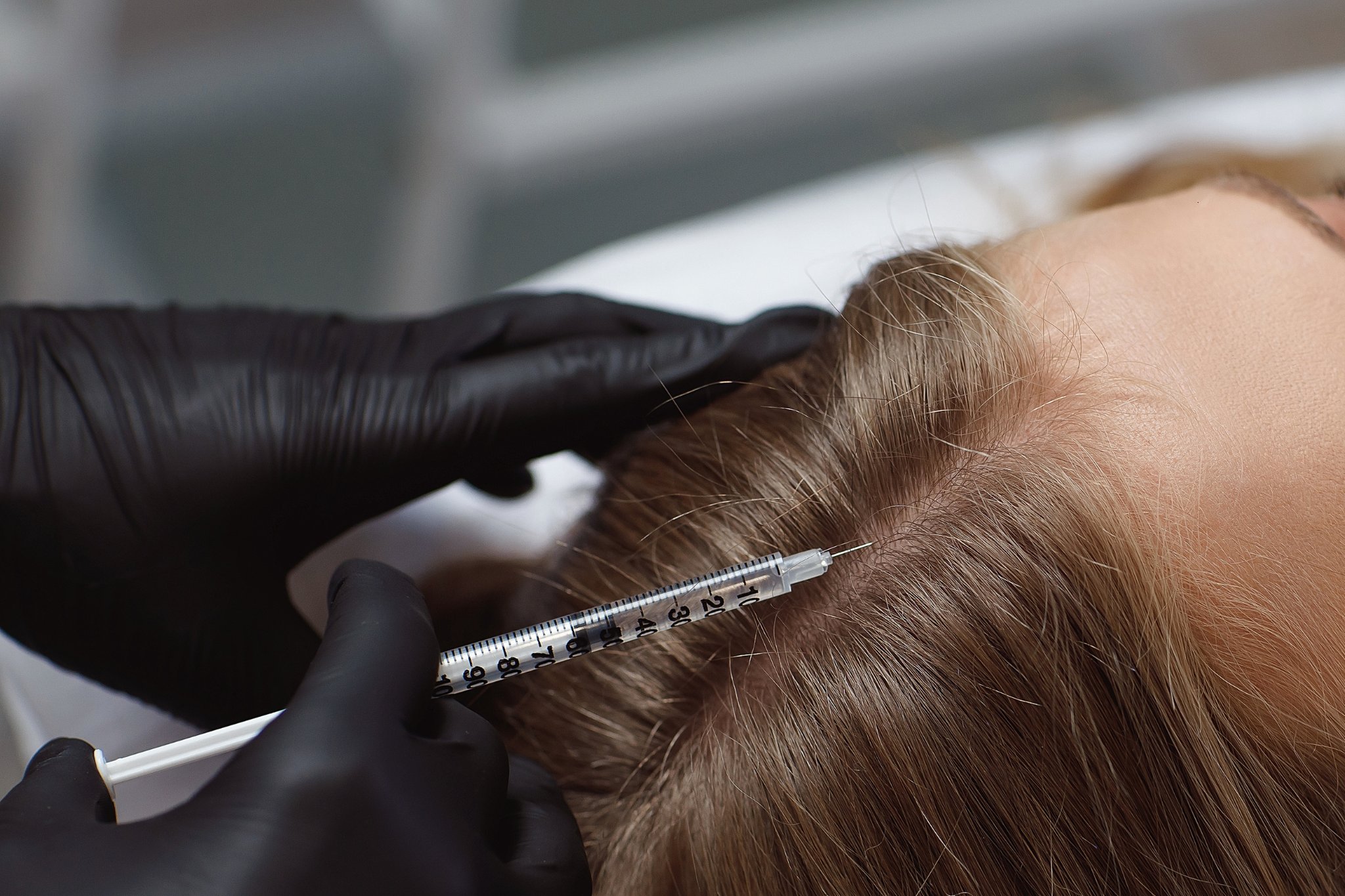 Séance de mésothérapie pour revitaliser le cuir chevelu d'une femme