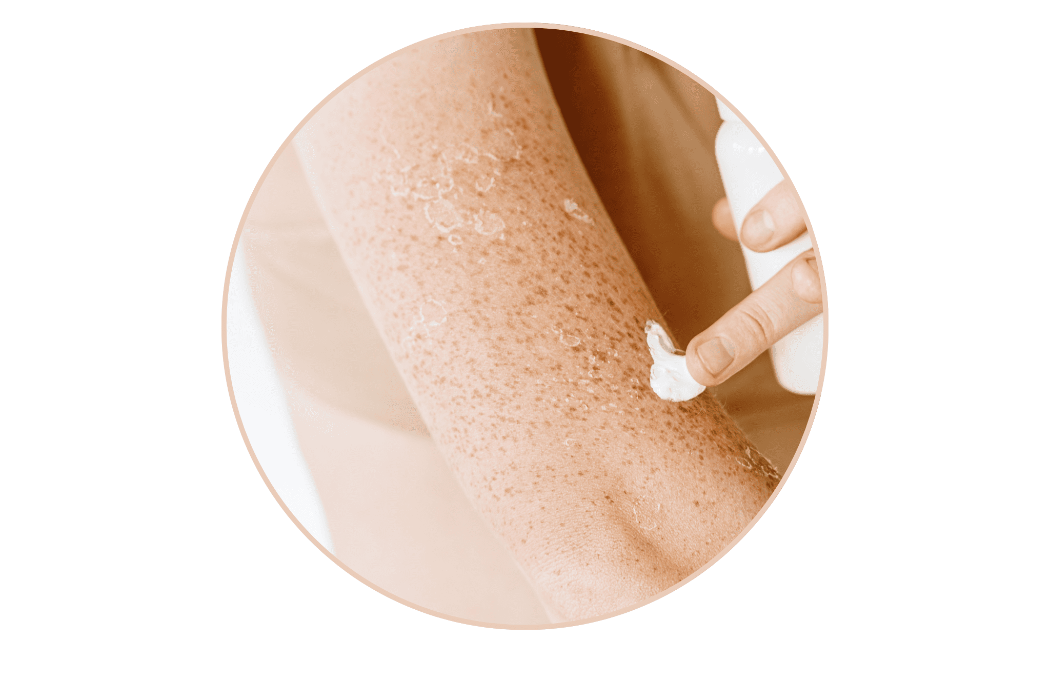 peau sensible avec des squames