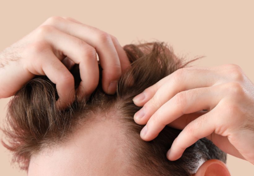 homme qui va faire une greffe en france suite à une perte de cheveux homme