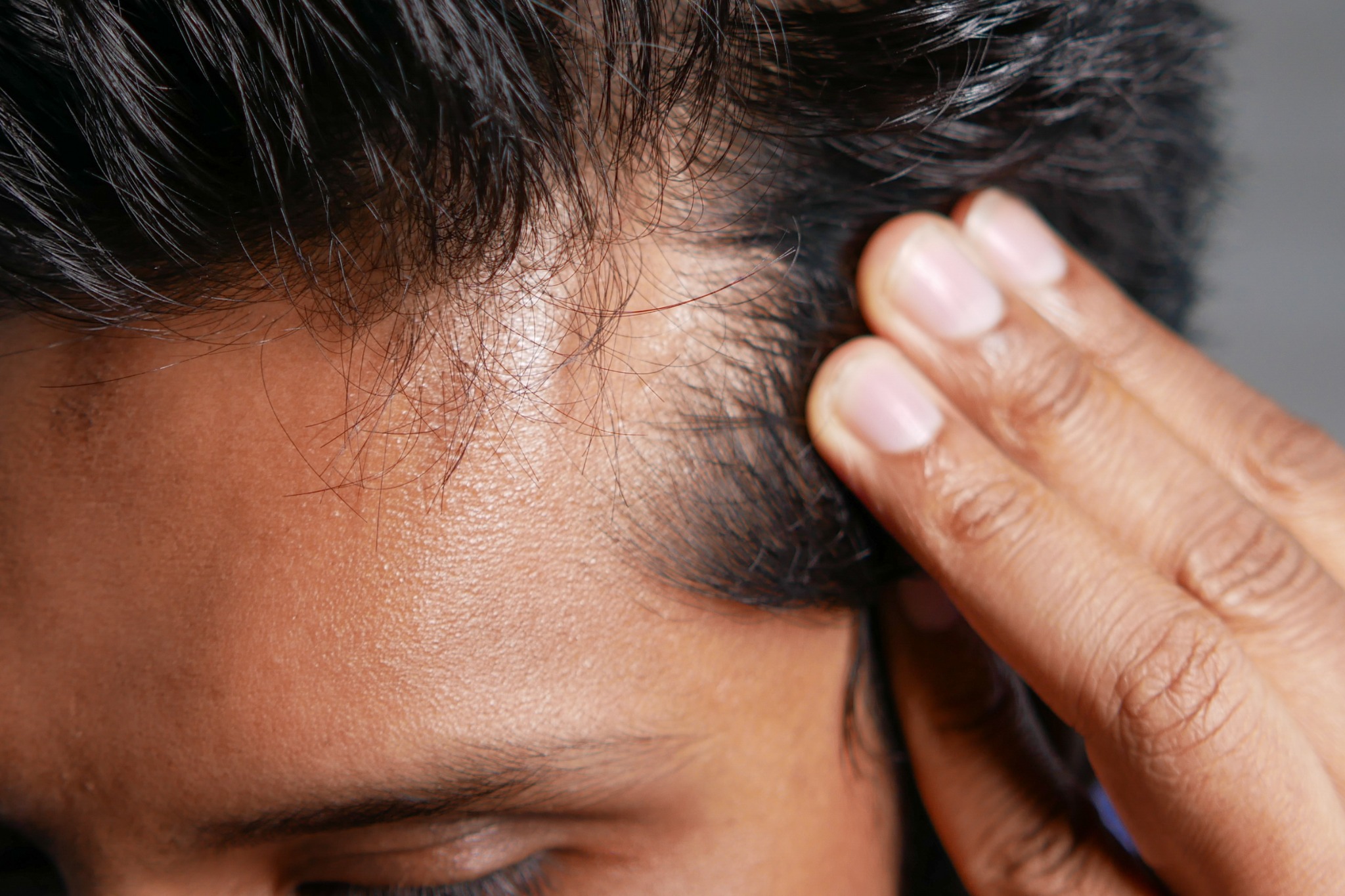 perte de cheveux saisonnière d'un homme