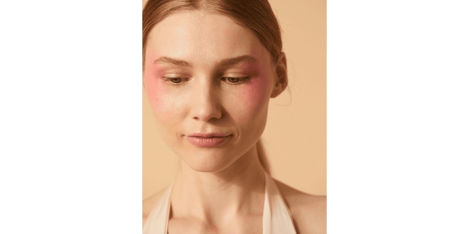 couperose au niveau joues et tempes