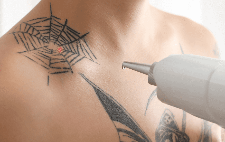 séance de détatouage d'une toile d'araignée sur l'épaule d'un homme