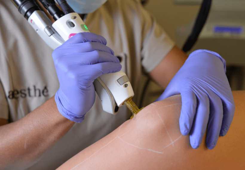 seance epilation laser chez aesthé
