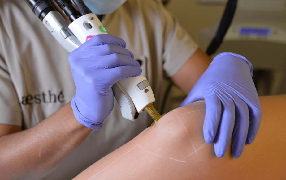 seance epilation laser chez aesthé