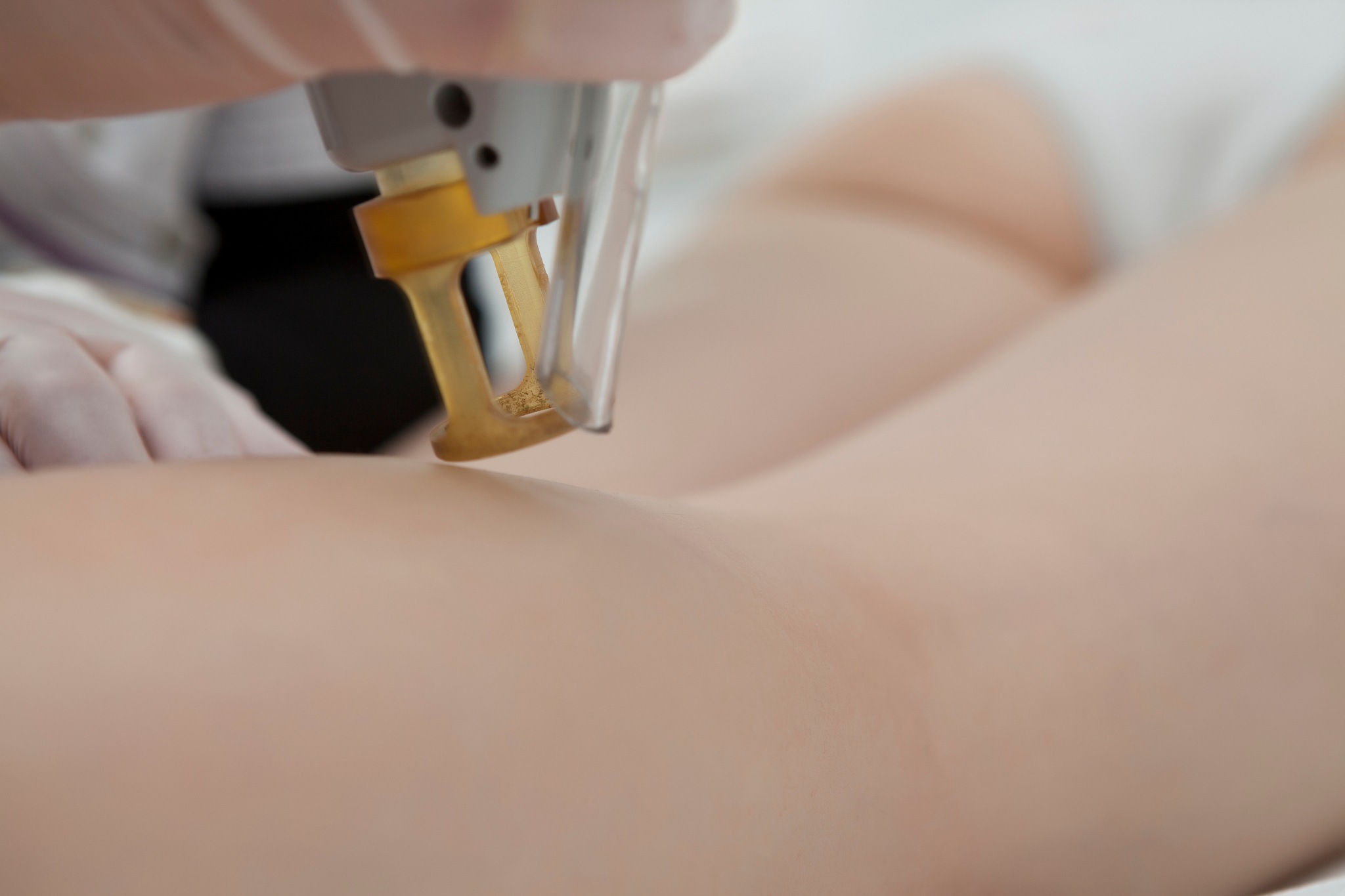 Une femme qui fait une séance d'épilation laser pour éliminer tous ses poils