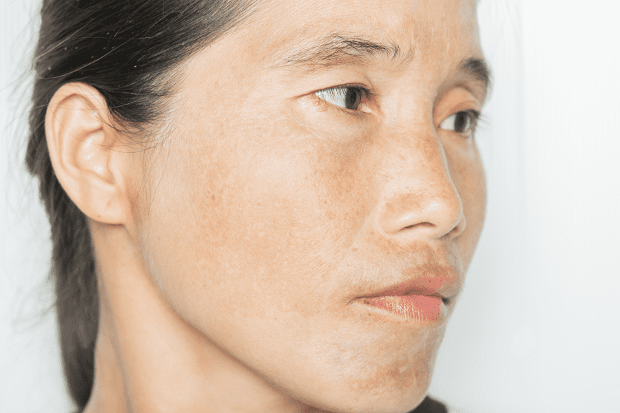 Une personne avec des taches pigmentaires brunes sur le corps et le visage