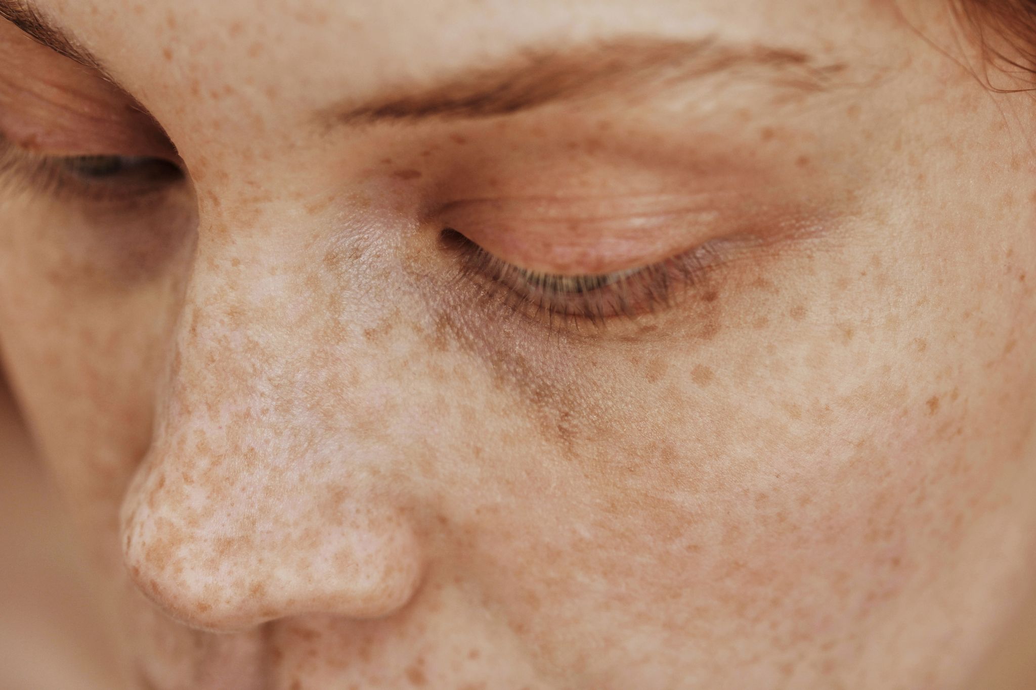 Une femme qui veut faire enlever ses taches de rousseurs avec le laser pigmentaire