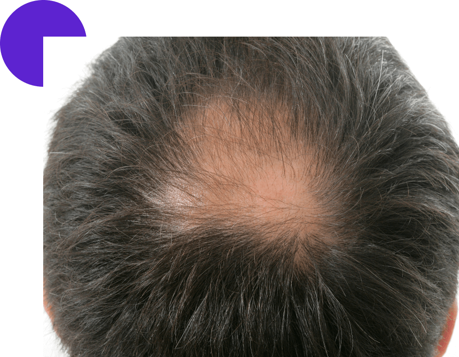 calvitie de tonsure homme 40 ans