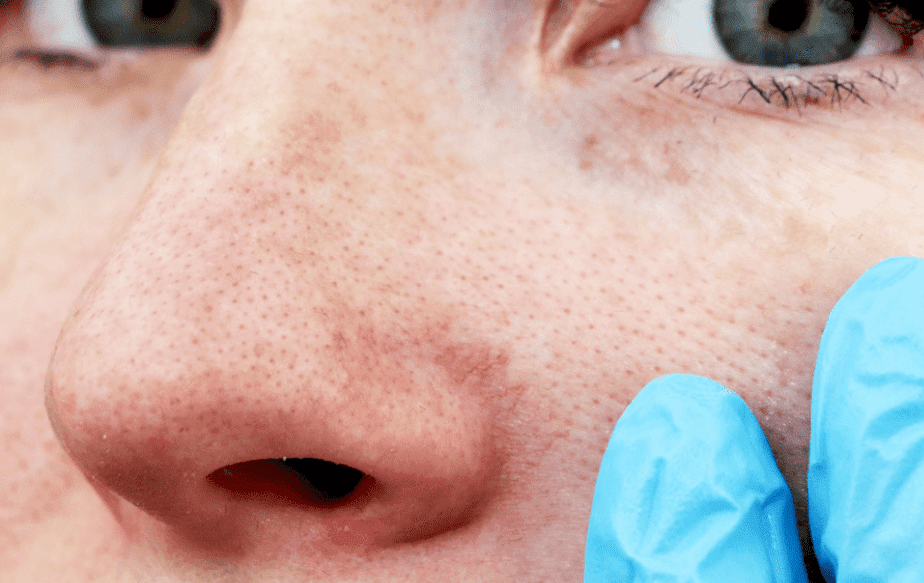 une femme qui vient soigner ses rougeurs chez aesthé