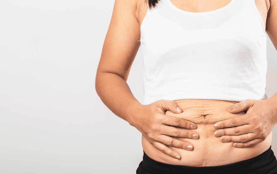 ventre d'une femme après son accouchement