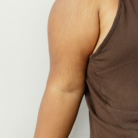 Une personne qui a des vergetures sur le bras