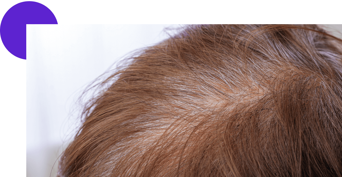 calvitie en haut du crâne, vertex